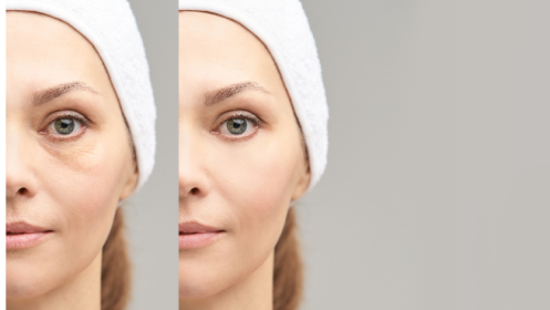 Tratamiento profesional para disimular las ojeras por solo 25 €