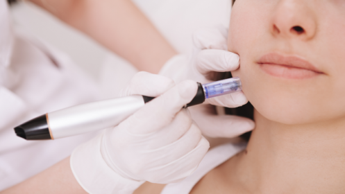 Sesión facial con Dermapen ¡por sólo 35 €!