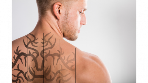 Láser picosegundos para eliminación de tatuajes 1 sesión por 50€